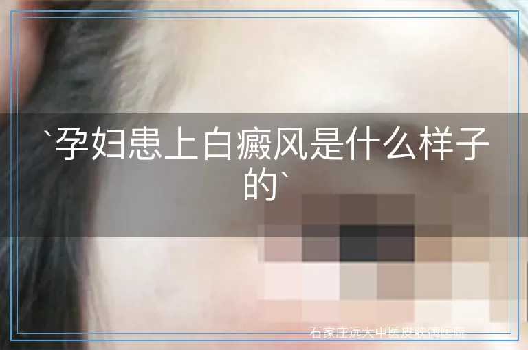 孕妇患上白癜风是什么样子的