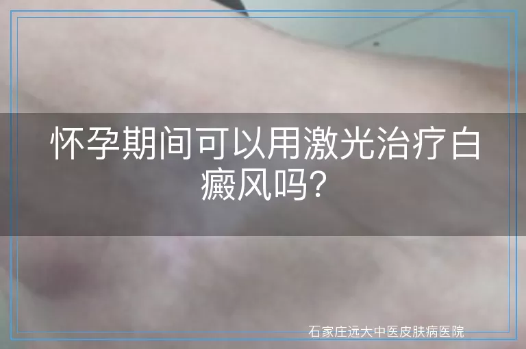 怀孕期间可以用激光治疗白癜风吗？
