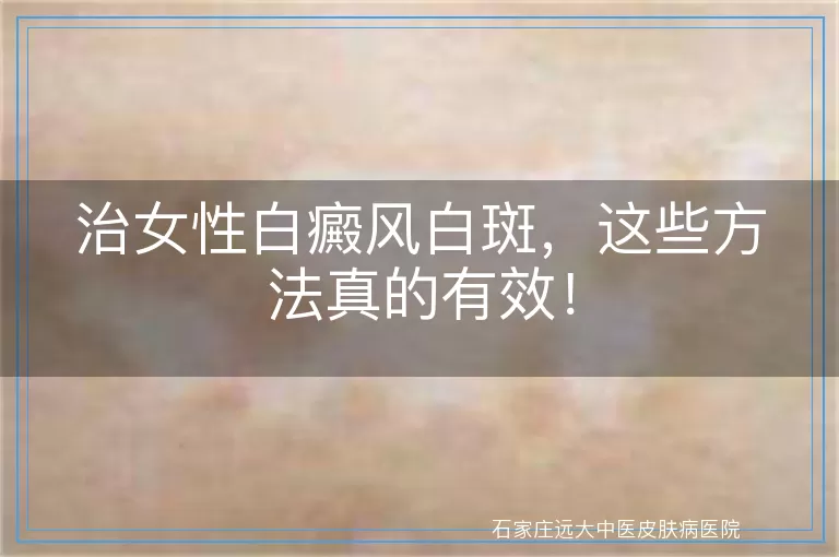 治女性白癜风白斑，这些方法真的有效！