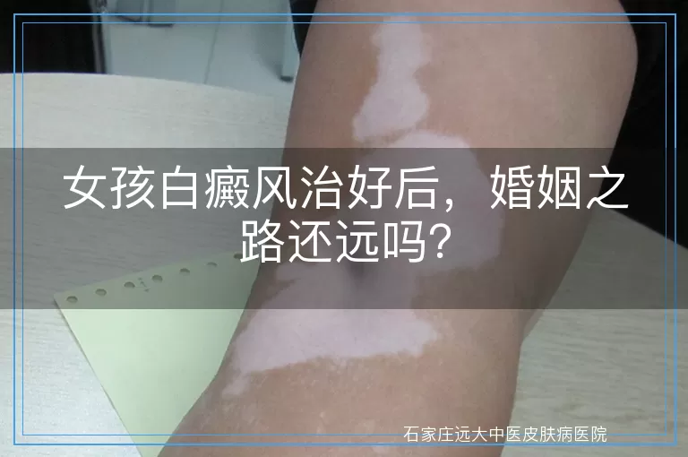 女孩白癜风治好后，婚姻之路还远吗？