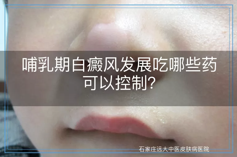 哺乳期白癜风发展吃哪些药可以控制？