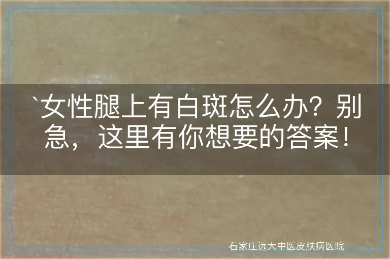 女性腿上有白斑怎么办？别急，这里有你想要的答案！