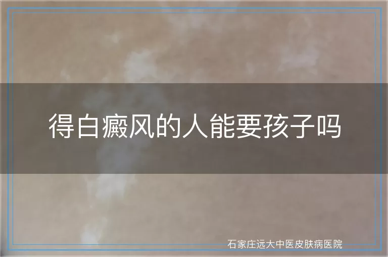 得白癜风的人能要孩子吗