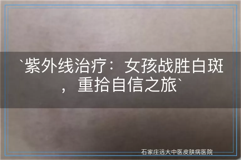 紫外线治疗：女孩战胜白斑，重拾自信之旅