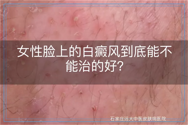 女性脸上的白癜风到底能不能治的好？