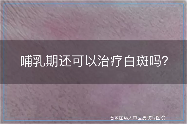 哺乳期还可以治疗白斑吗？