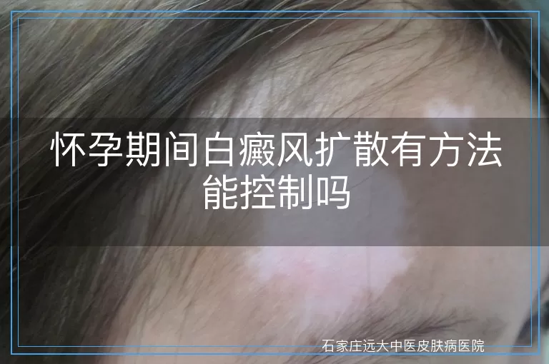 怀孕期间白癜风扩散有方法能控制吗
