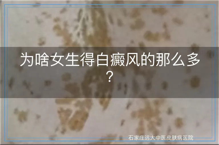 为啥女生得白癜风的那么多？