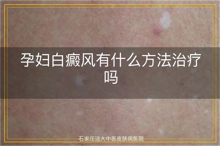 孕妇白癜风有什么方法治疗吗