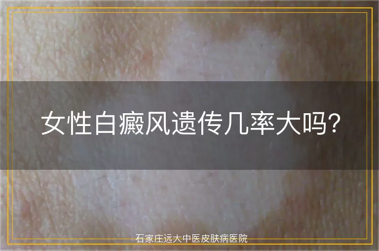女性白癜风遗传几率大吗？