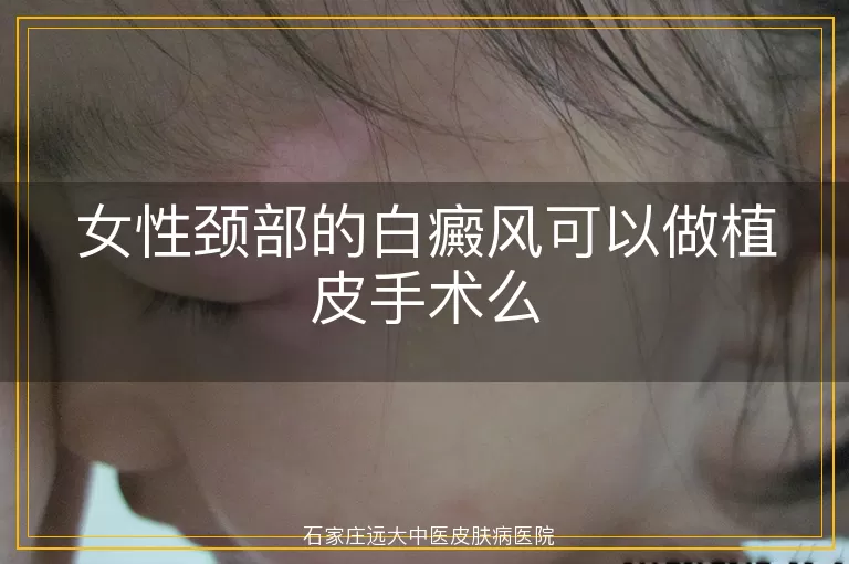 女性颈部的白癜风可以做植皮手术么