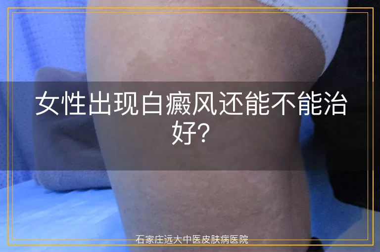 女性出现白癜风还能不能治好？