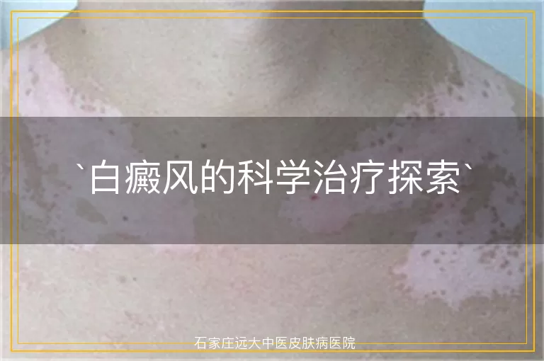白癜风的科学治疗探索