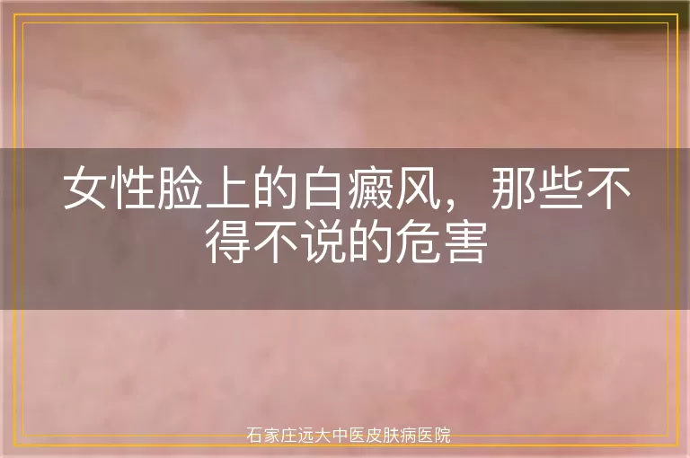 女性脸上的白癜风，那些不得不说的危害