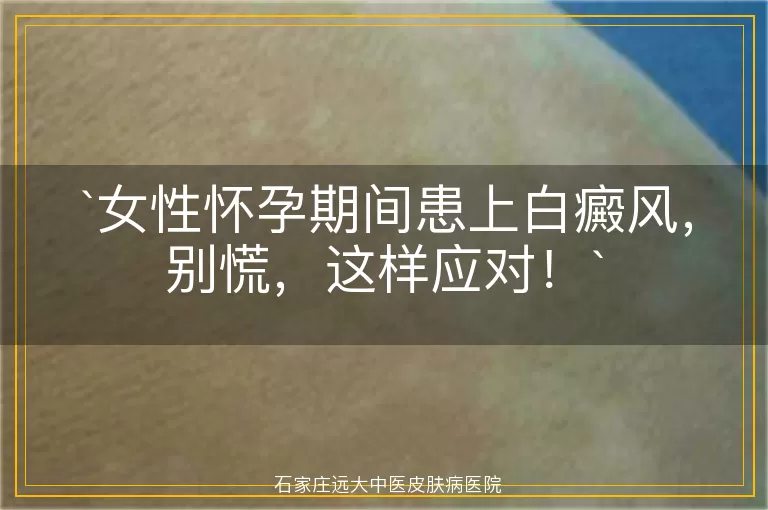 女性怀孕期间患上白癜风，别慌，这样应对！