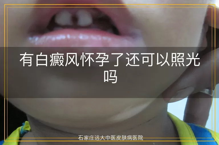 有白癜风怀孕了还可以照光吗