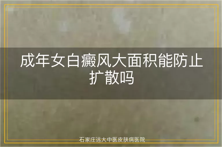 成年女白癜风大面积能防止扩散吗