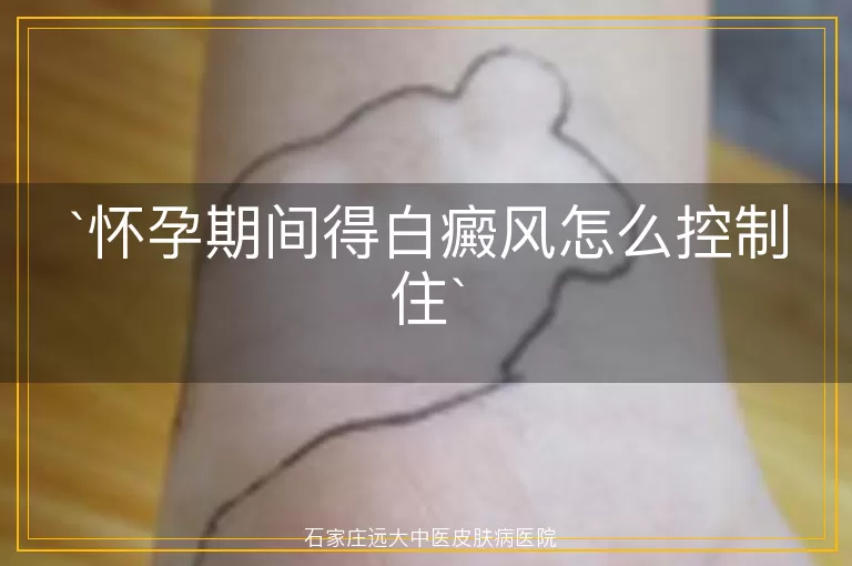 怀孕期间得白癜风怎么控制住