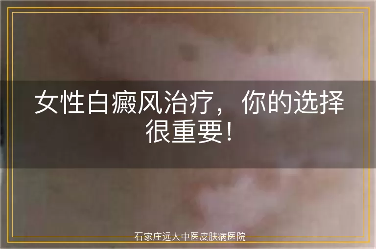 女性白癜风治疗，你的选择很重要！