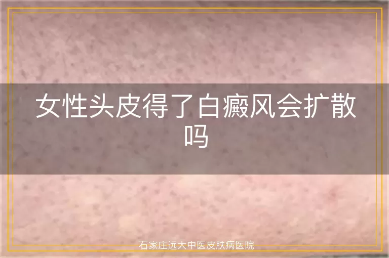 女性头皮得了白癜风会扩散吗