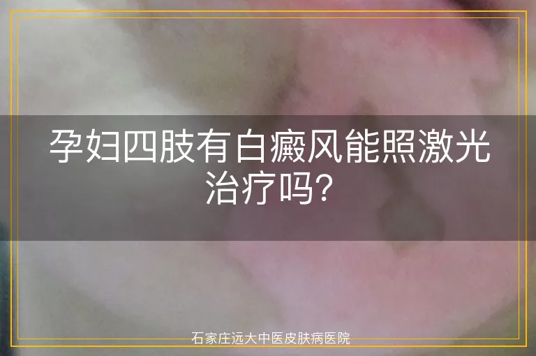 孕妇四肢有白癜风能照激光治疗吗？