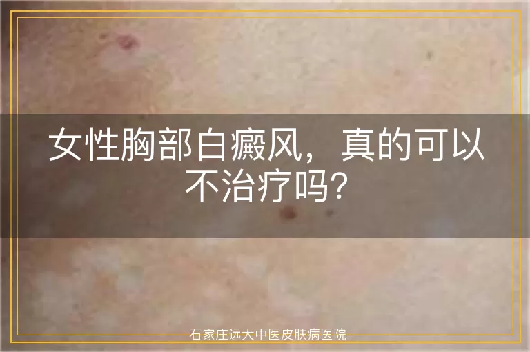 女性胸部白癜风，真的可以不治疗吗？