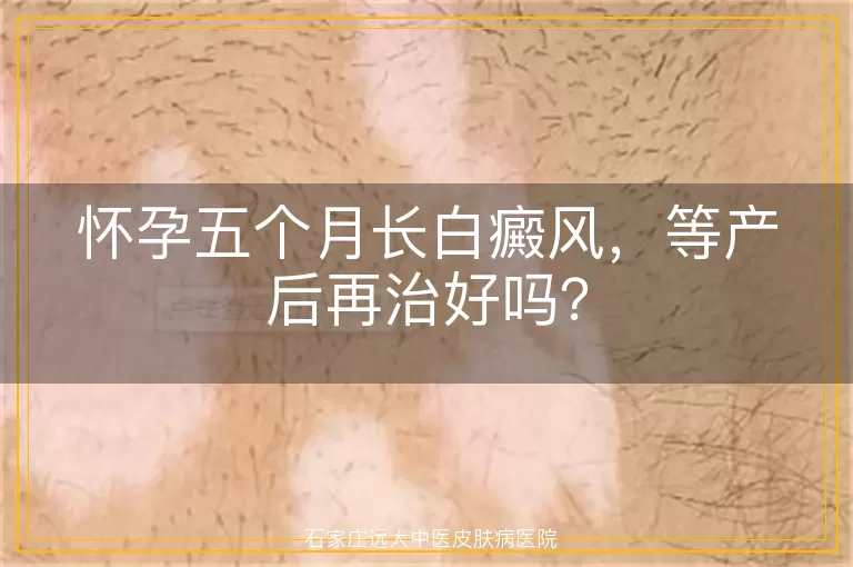 怀孕五个月长白癜风，等产后再治好吗？