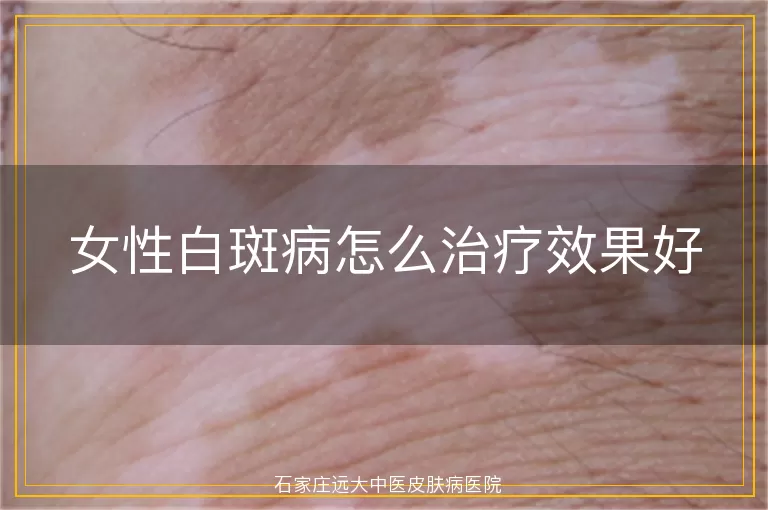 女性白斑病怎么治疗效果好