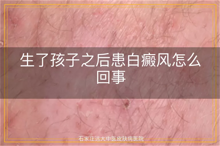 生了孩子之后患白癜风怎么回事