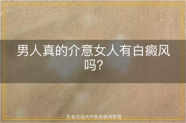 男人真的介意女人有白癜风吗？