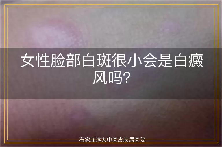 女性脸部白斑很小会是白癜风吗？
