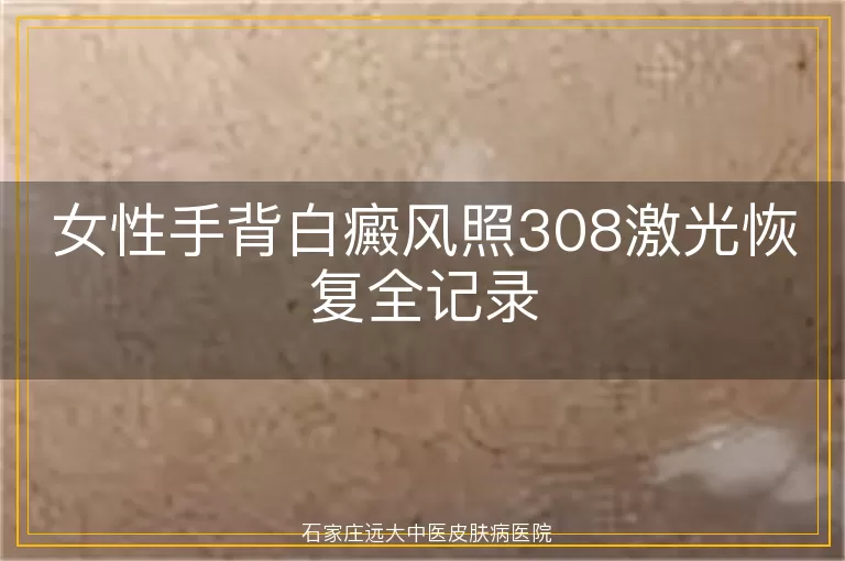 女性手背白癜风照308激光恢复全记录