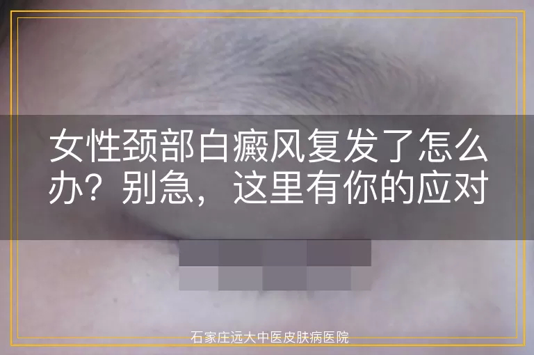 女性颈部白癜风复发了怎么办？别急，这里有你的应对指南！