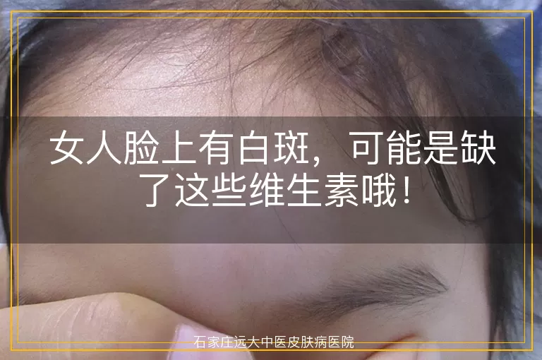 女人脸上有白斑，可能是缺了这些维生素哦！