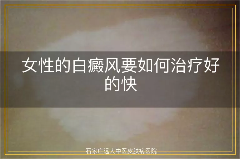 女性的白癜风要如何治疗好的快