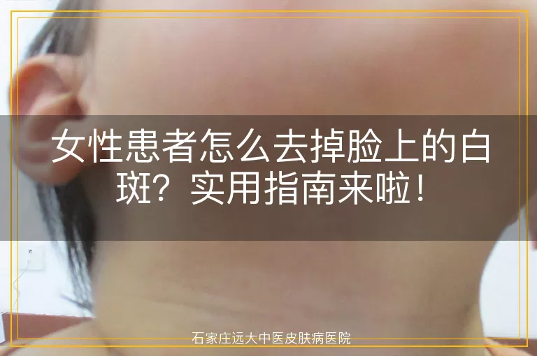 女性患者怎么去掉脸上的白斑？实用指南来啦！