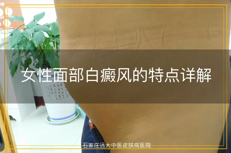 女性面部白癜风的特点详解