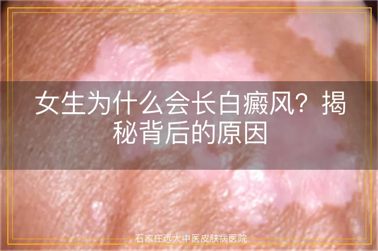 女生为什么会长白癜风？揭秘背后的原因