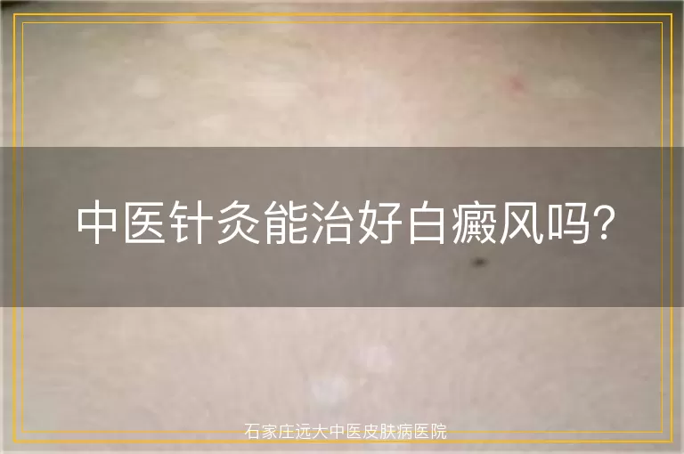 中医针灸能治好白癜风吗？