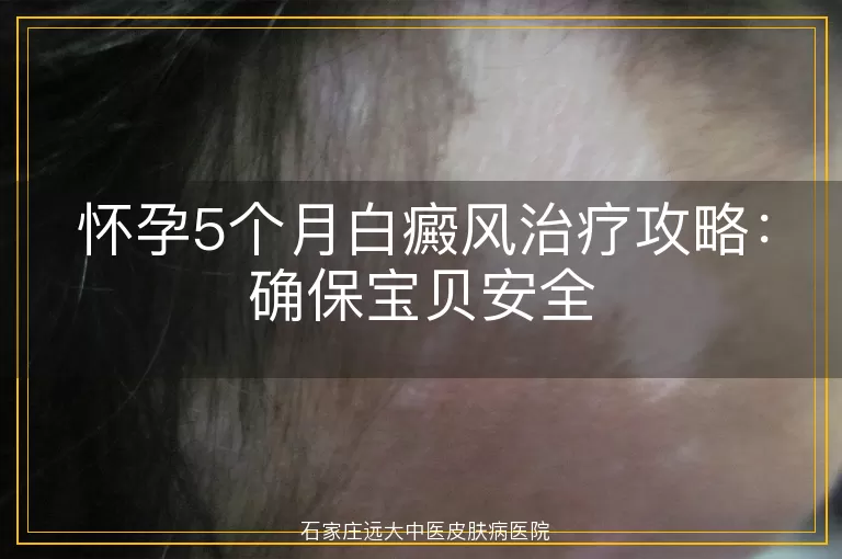 怀孕5个月白癜风治疗攻略：确保宝贝安全