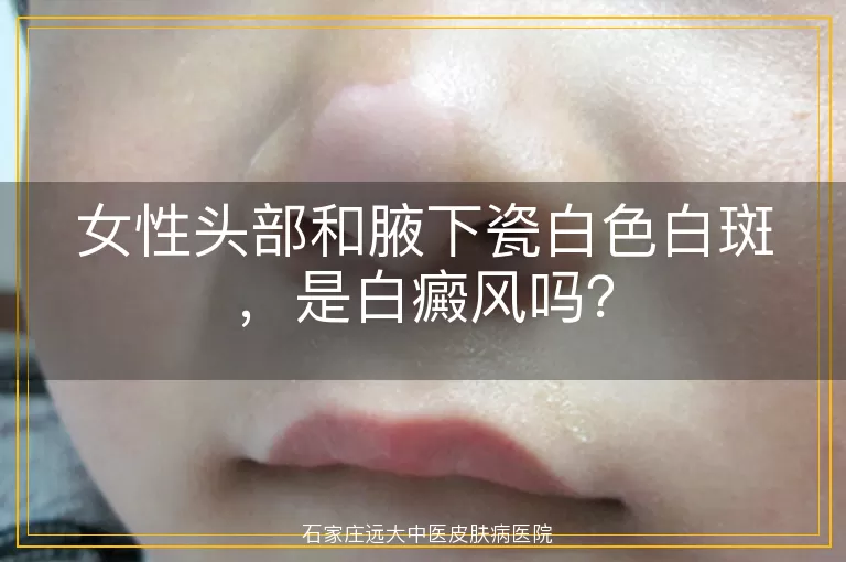 女性头部和腋下瓷白色白斑，是白癜风吗？
