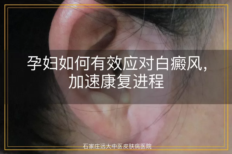 孕妇如何有效应对白癜风，加速康复进程