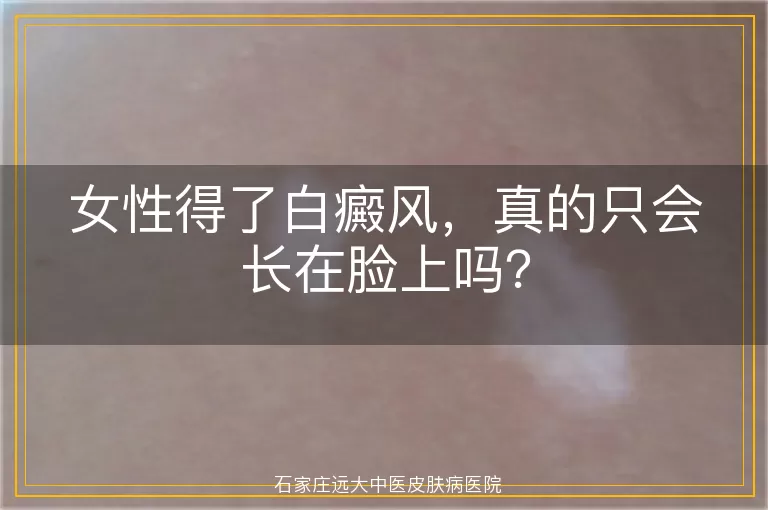 女性得了白癜风，真的只会长在脸上吗？