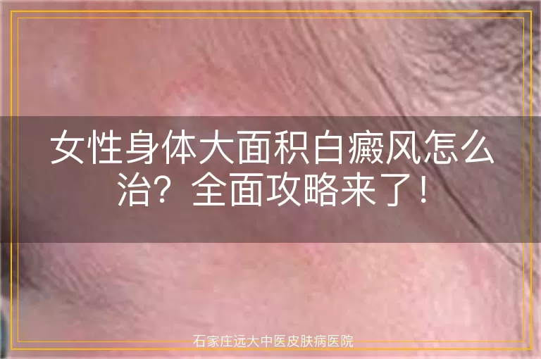 女性身体大面积白癜风怎么治？全面攻略来了！