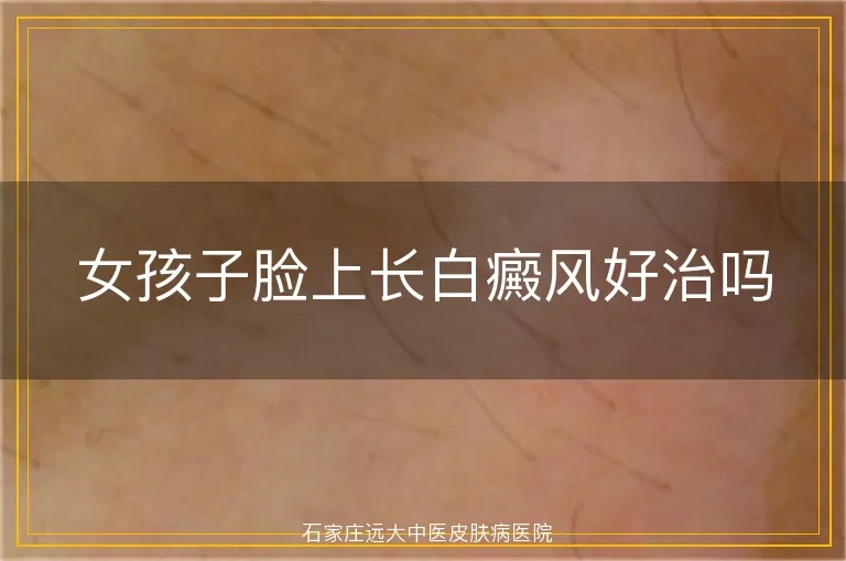 女孩子脸上长白癜风好治吗