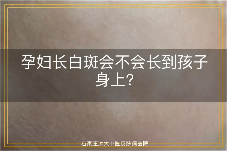 孕妇长白斑会不会长到孩子身上？