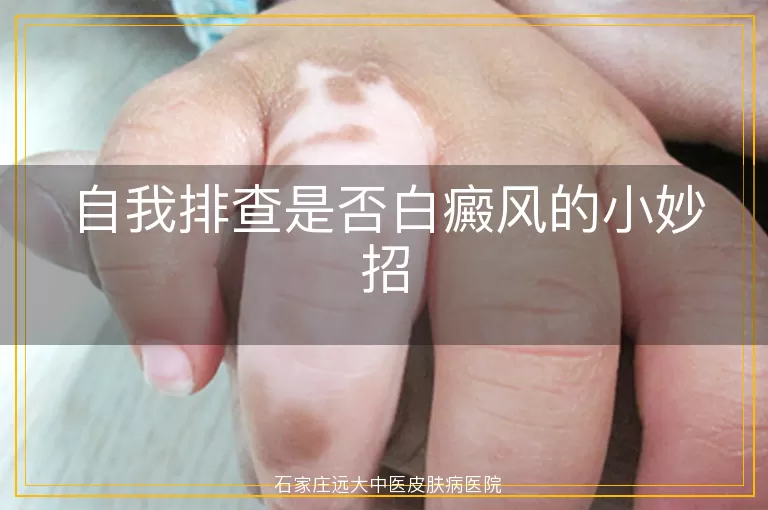 自我排查是否白癜风的小妙招