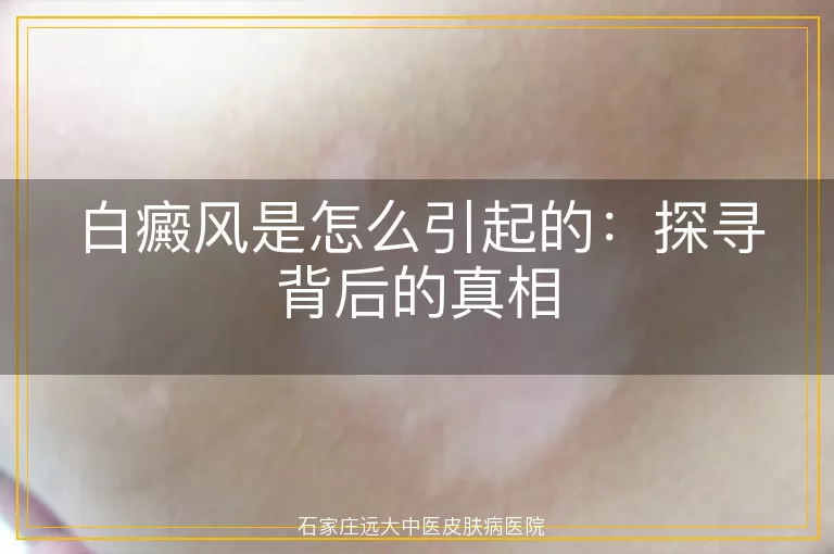 白癜风是怎么引起的：探寻背后的真相