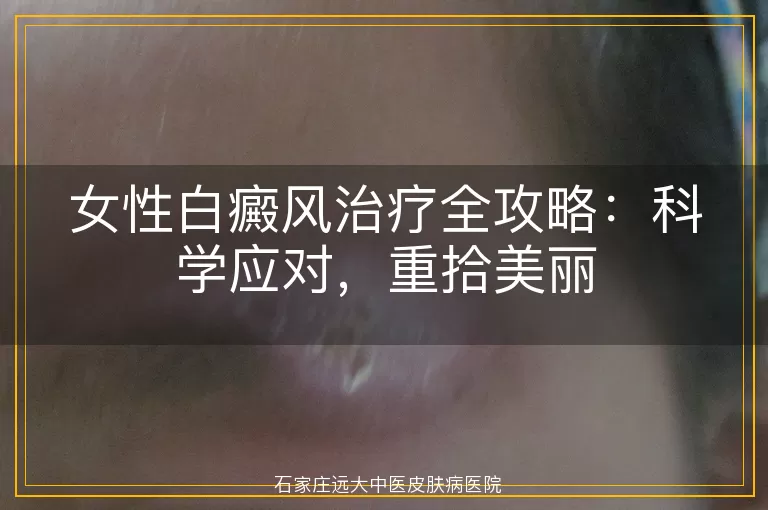 女性白癜风治疗全攻略：科学应对，重拾美丽