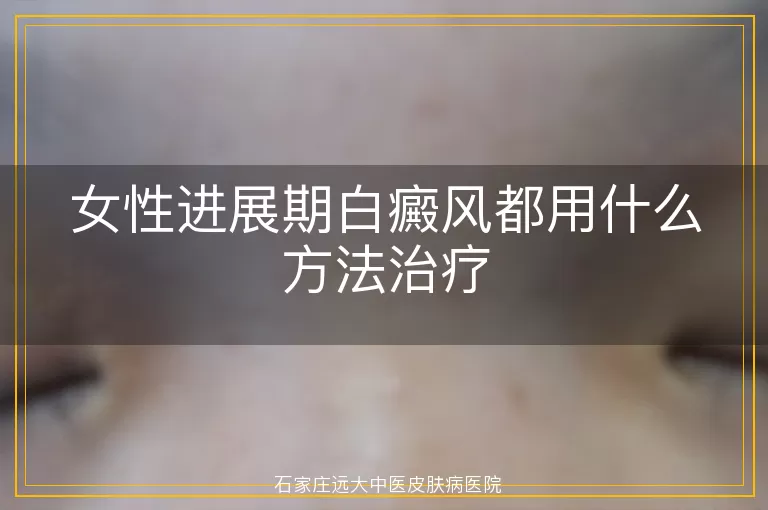 女性进展期白癜风都用什么方法治疗